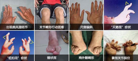 郑州痛风风湿病医院类风湿性关节炎可造成手指、脚趾等多处关节畸形.jpg