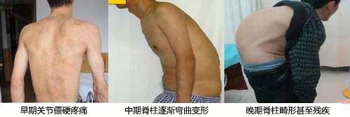郑州痛风风湿病医院强直性脊柱炎的各期症状表现图.jpg