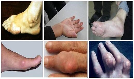 郑州痛风风湿病医院手足痛风给患者造成危害 .jpg